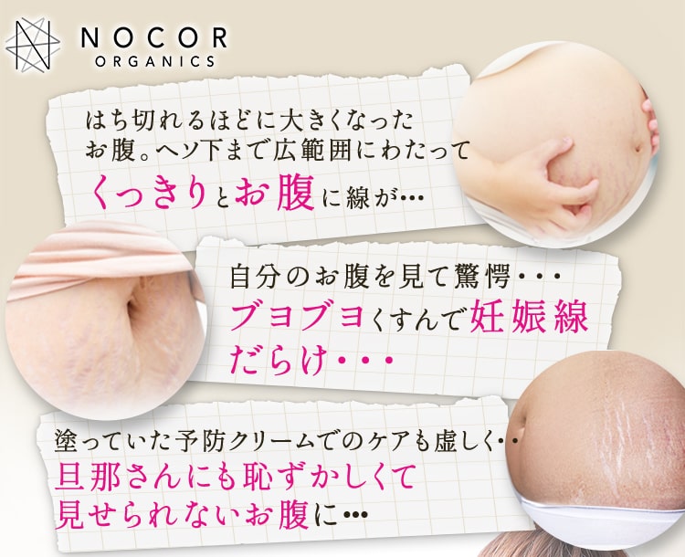 太もも・お尻、お腹 できてしまっても大丈夫！妊娠線･･･ あきらめないで！